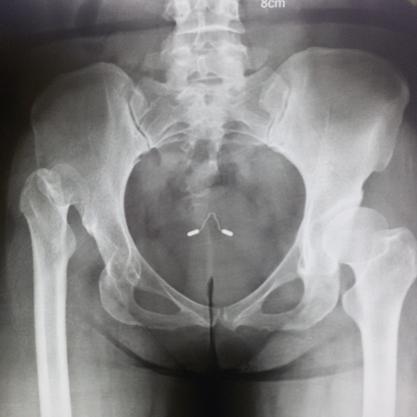 先天性髖關節脫位